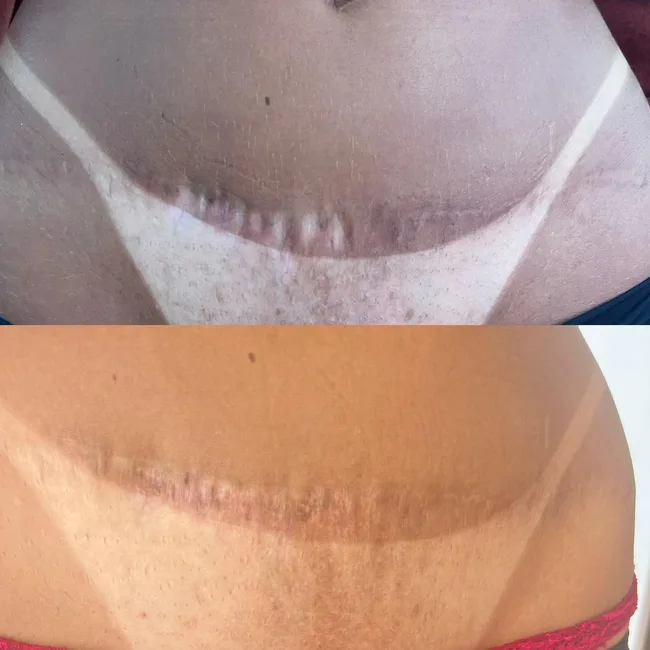 Camuflagem resultado